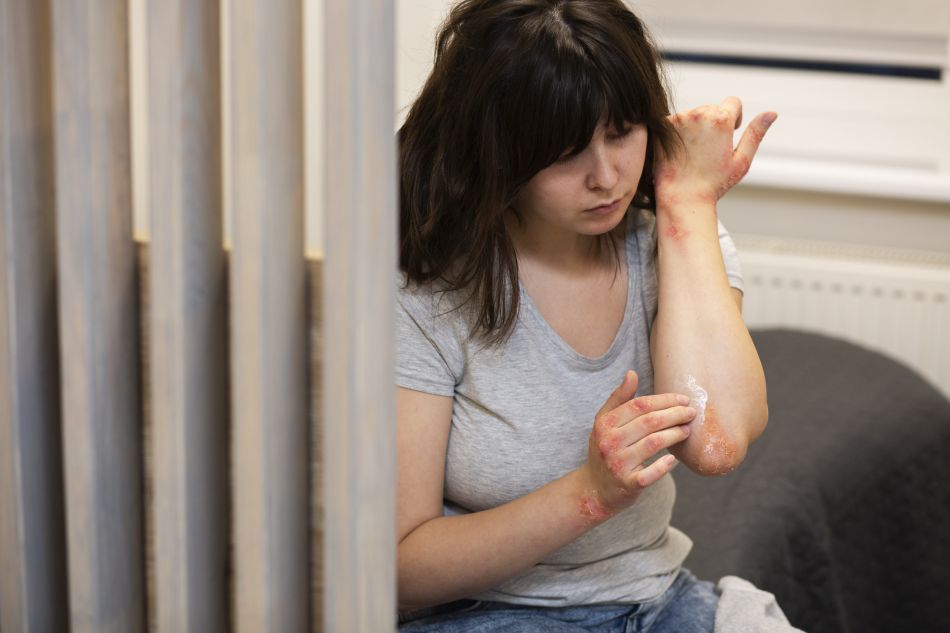 bőrbetegség Az atópiás dermatitisz sokszor a könyéknél jelentkezik. Fotó: Freepik